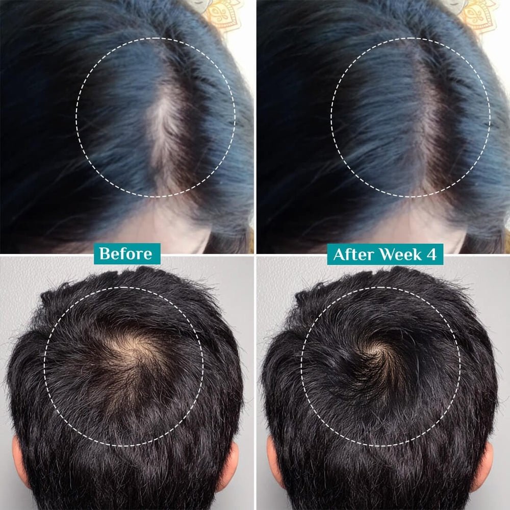 Pilgrim Advanced Hair Growth Serum Roll-On with 3% Redensyl, 4% Anagain, 5% Capilia Stem Cell Complex & Korean Black Rice - 25ml